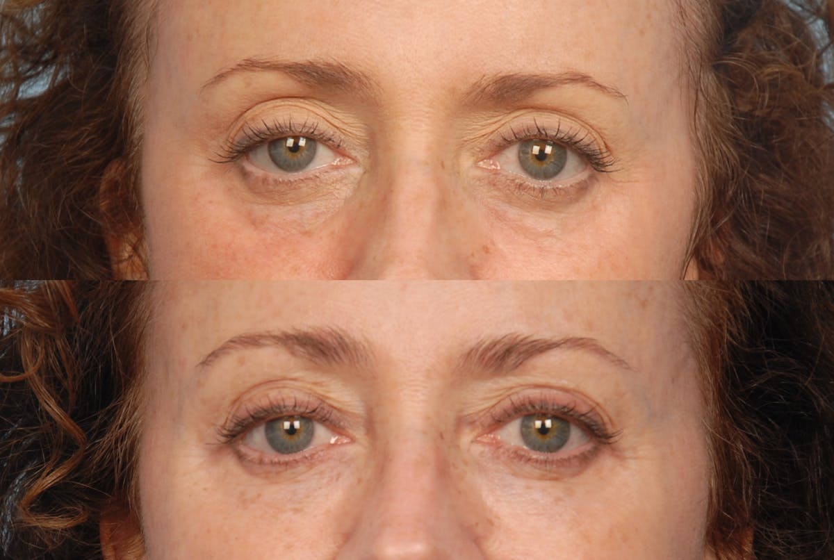Eyes Before & After Gallery - Patient 730596 - Image 1