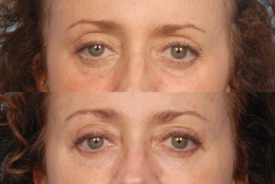 Eyes Before & After Gallery - Patient 730596 - Image 1