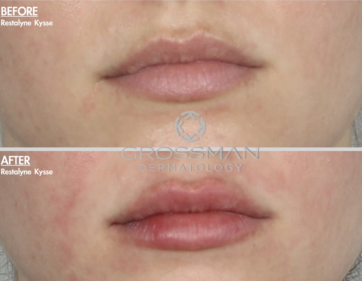 Lips Before & After Gallery - Patient 978151 - Image 1