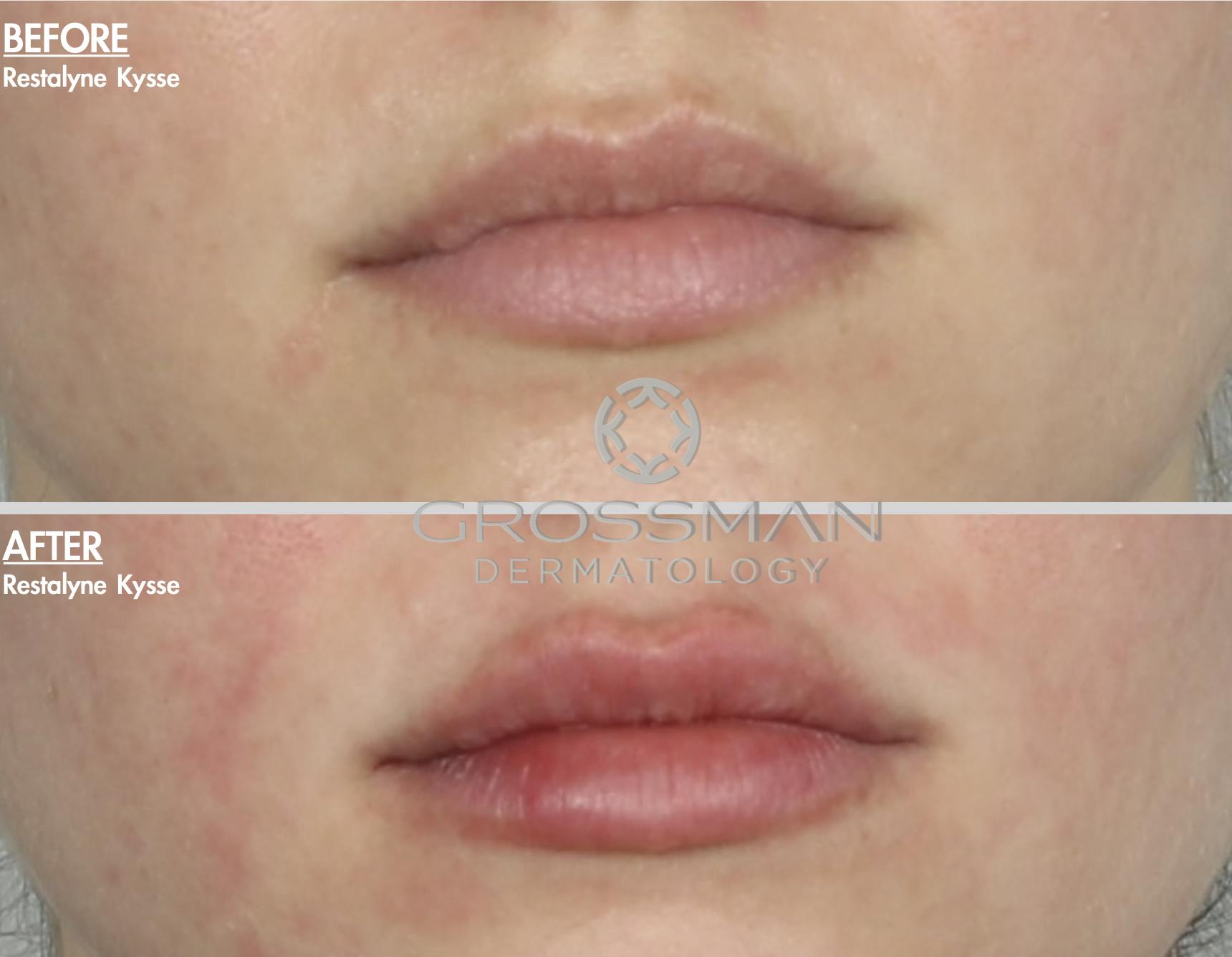 Restylane Before & After Gallery - Patient 48370098 - Image 1