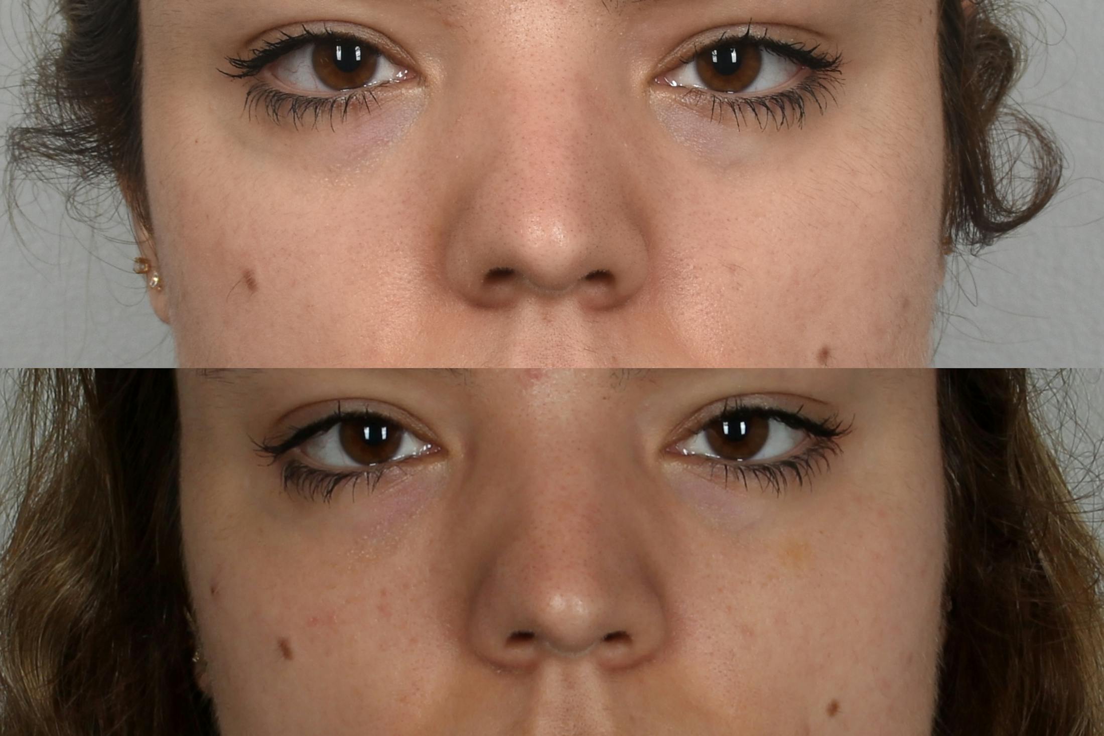 Under Eye Filler Before & After Gallery - Patient 48370099 - Image 1