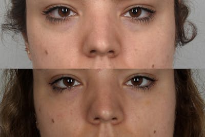 Eyes Before & After Gallery - Patient 565145 - Image 1