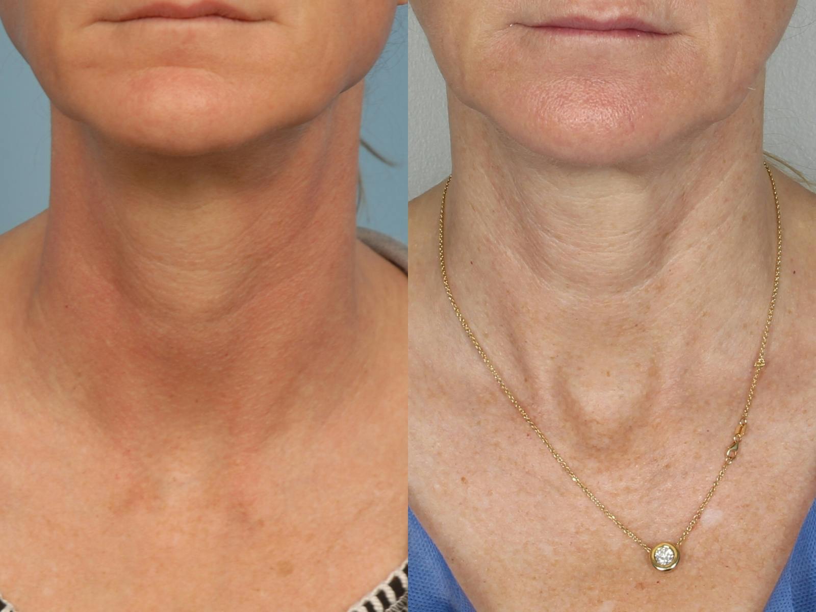 Active FX Laser Before & After Gallery - Patient 48370125 - Image 1