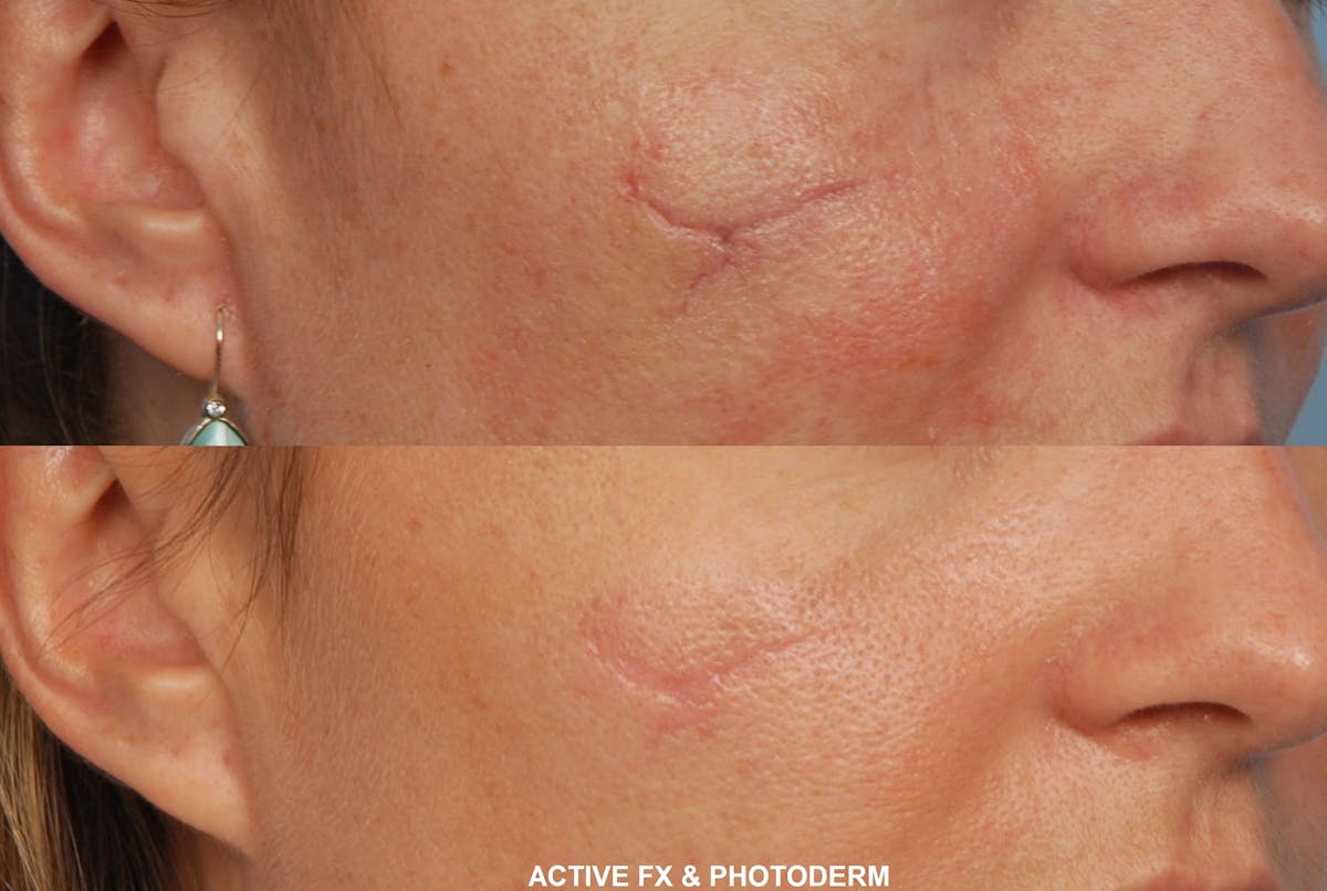 Active FX Laser Before & After Gallery - Patient 48370126 - Image 1