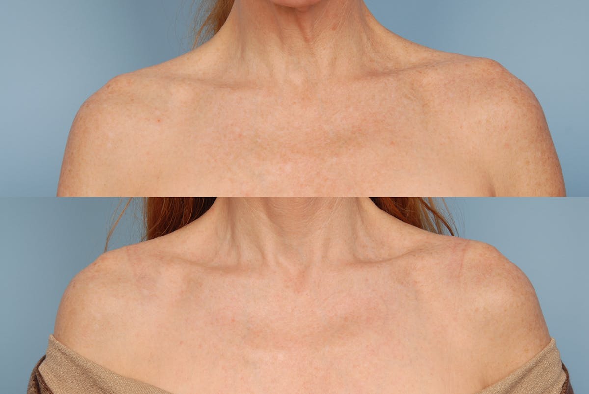 Active FX Laser Before & After Gallery - Patient 48370159 - Image 1