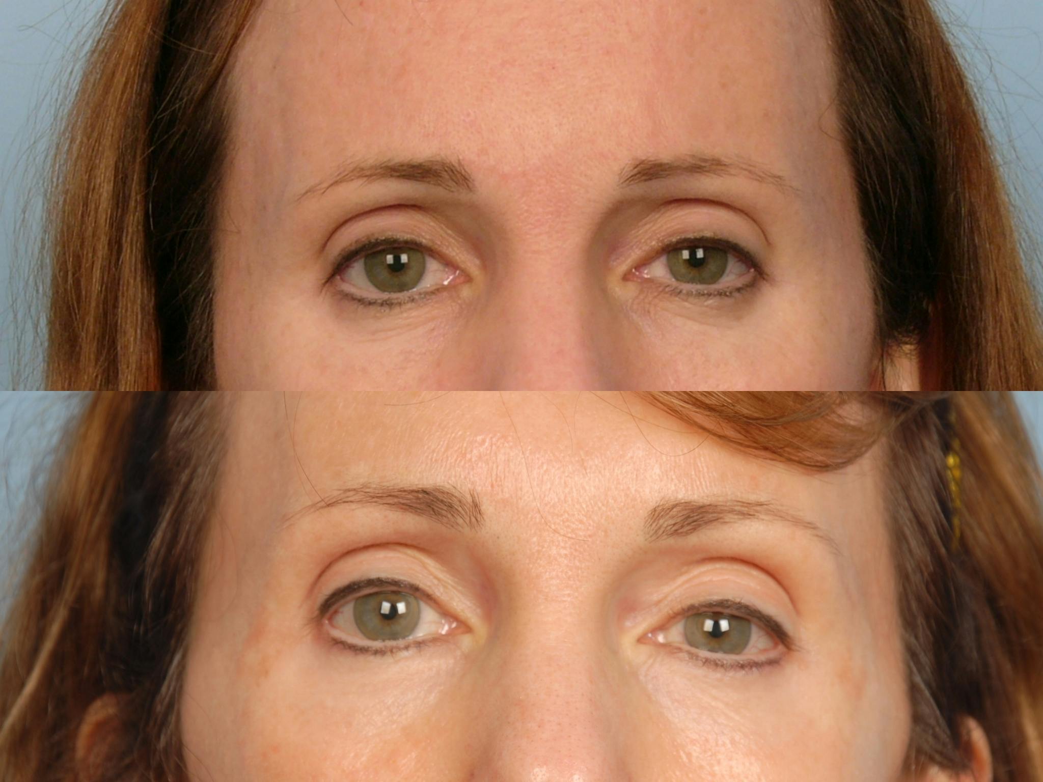 Active FX Laser Before & After Gallery - Patient 48370161 - Image 1