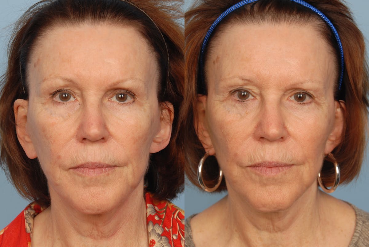Cosmelan Before & After Gallery - Patient 48370192 - Image 1