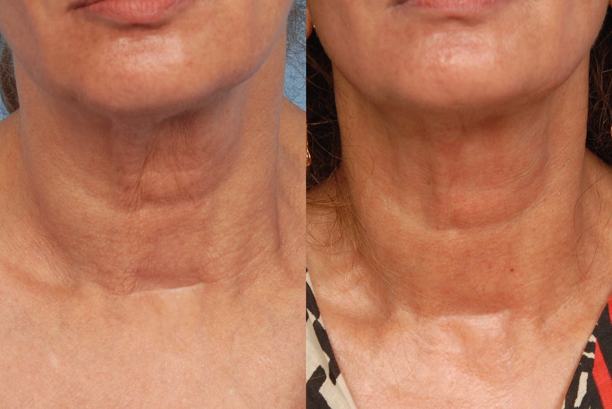 Cosmelan Before & After Gallery - Patient 48370193 - Image 1