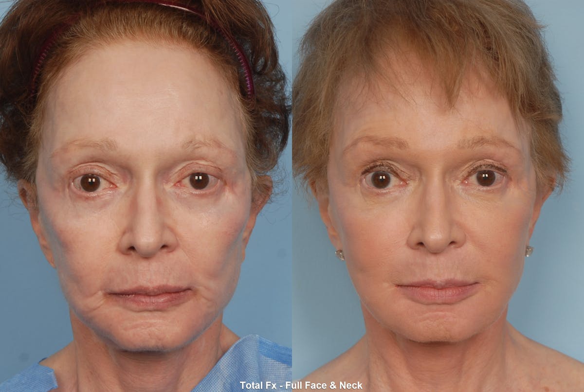Active FX Laser Before & After Gallery - Patient 48370198 - Image 1