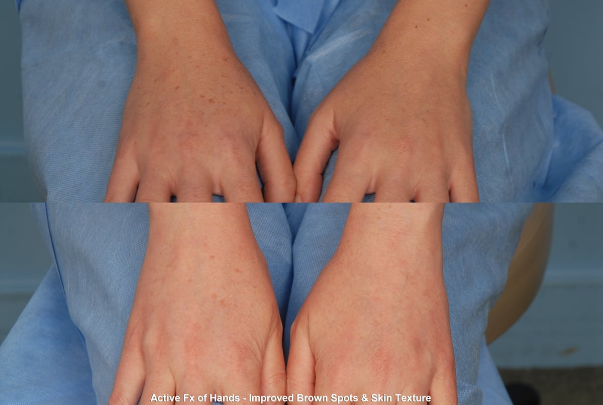 Active FX Laser Before & After Gallery - Patient 48370199 - Image 1