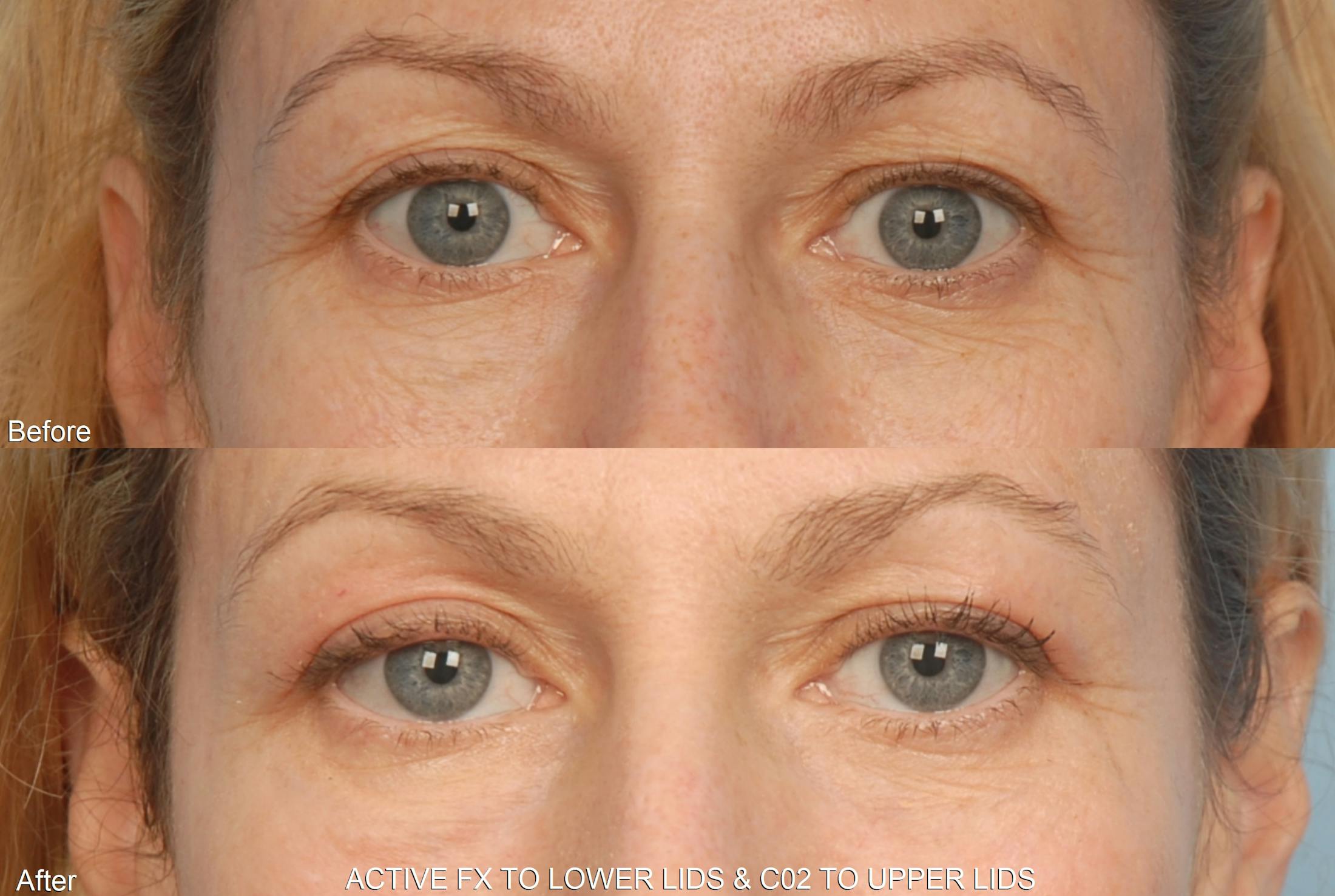 Active FX Laser Before & After Gallery - Patient 48370200 - Image 1