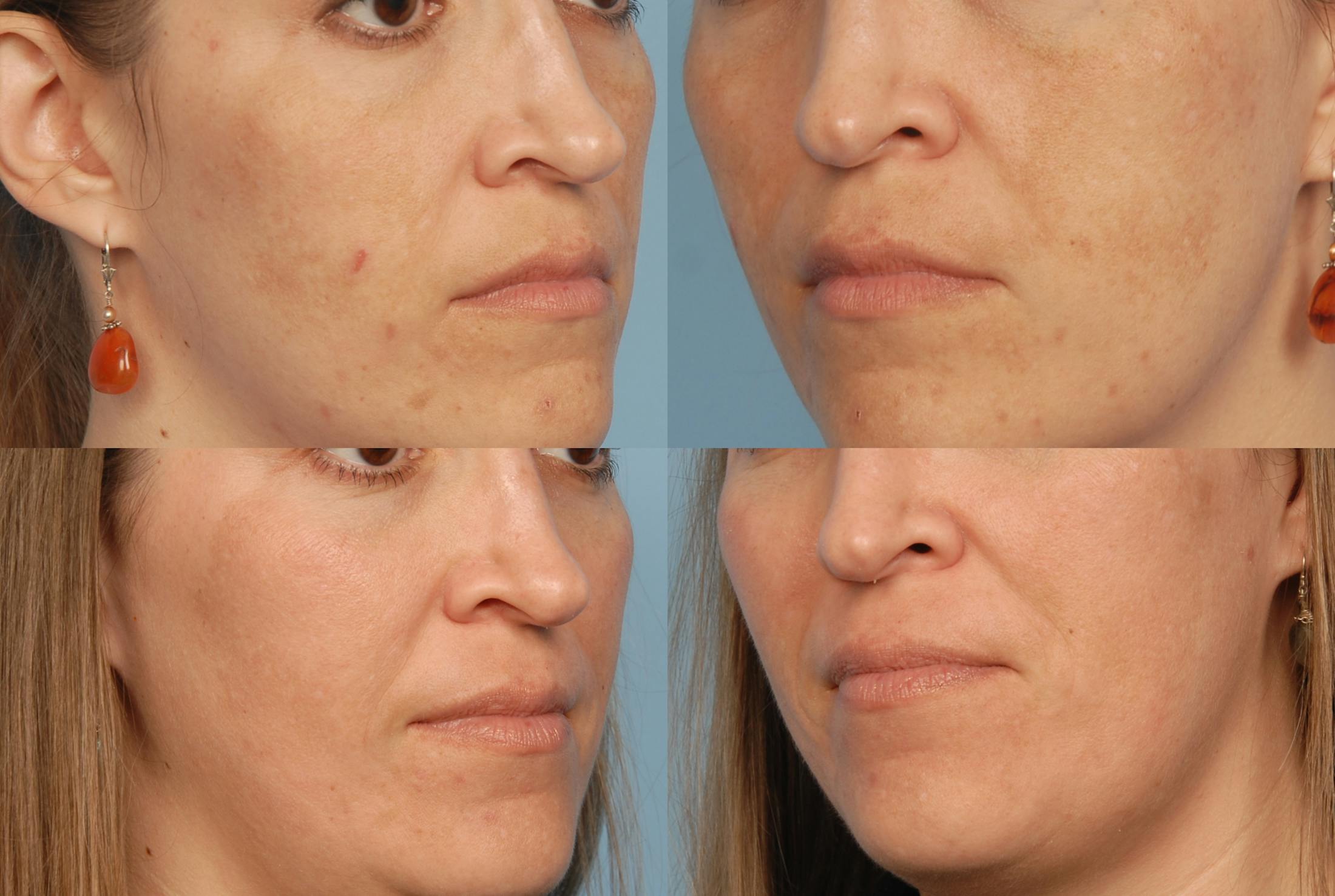 Fraxel Laser Before & After Gallery - Patient 48370213 - Image 1