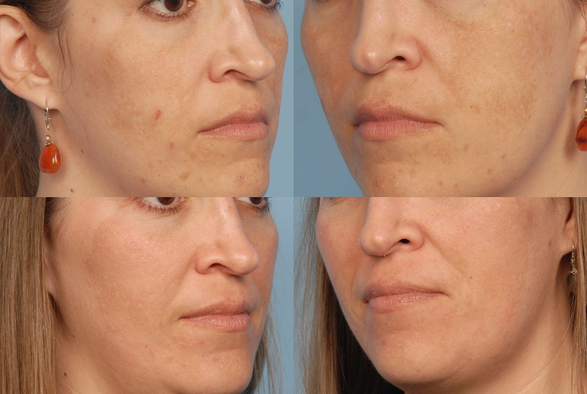 Fraxel Laser Before & After Gallery - Patient 48370213 - Image 1