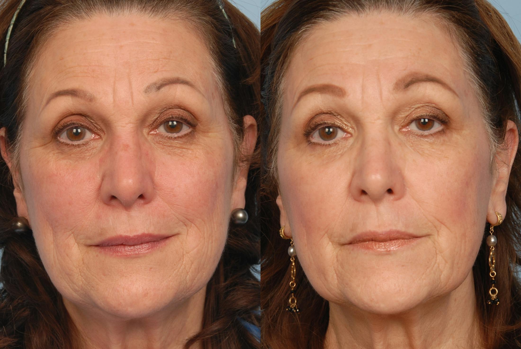 Fraxel Laser Before & After Gallery - Patient 48370214 - Image 1