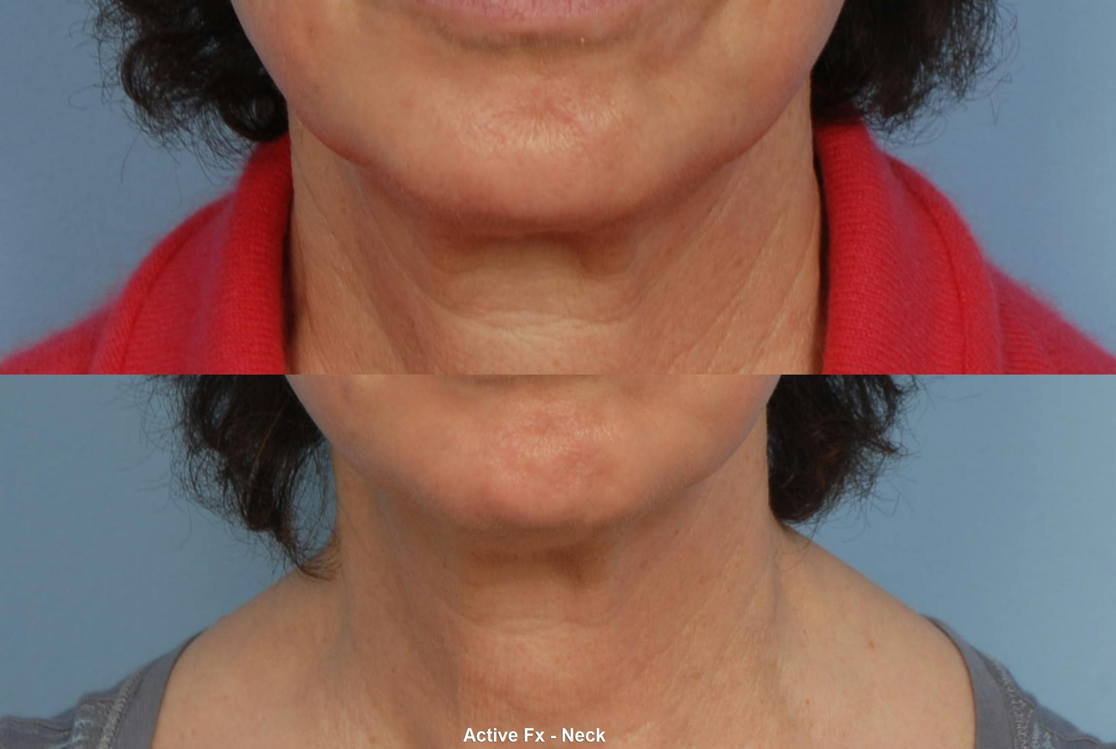 Active FX Laser Before & After Gallery - Patient 48370216 - Image 1