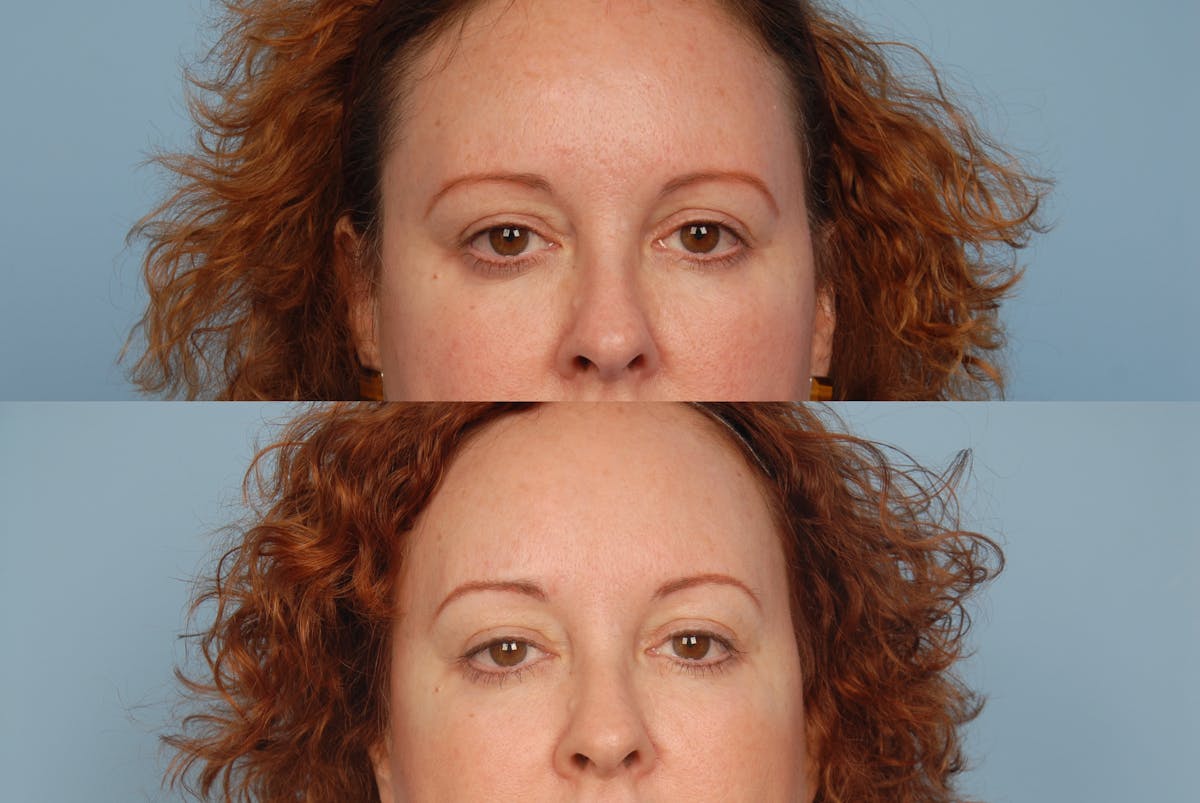 Photoderm Before & After Gallery - Patient 42065727 - Image 2