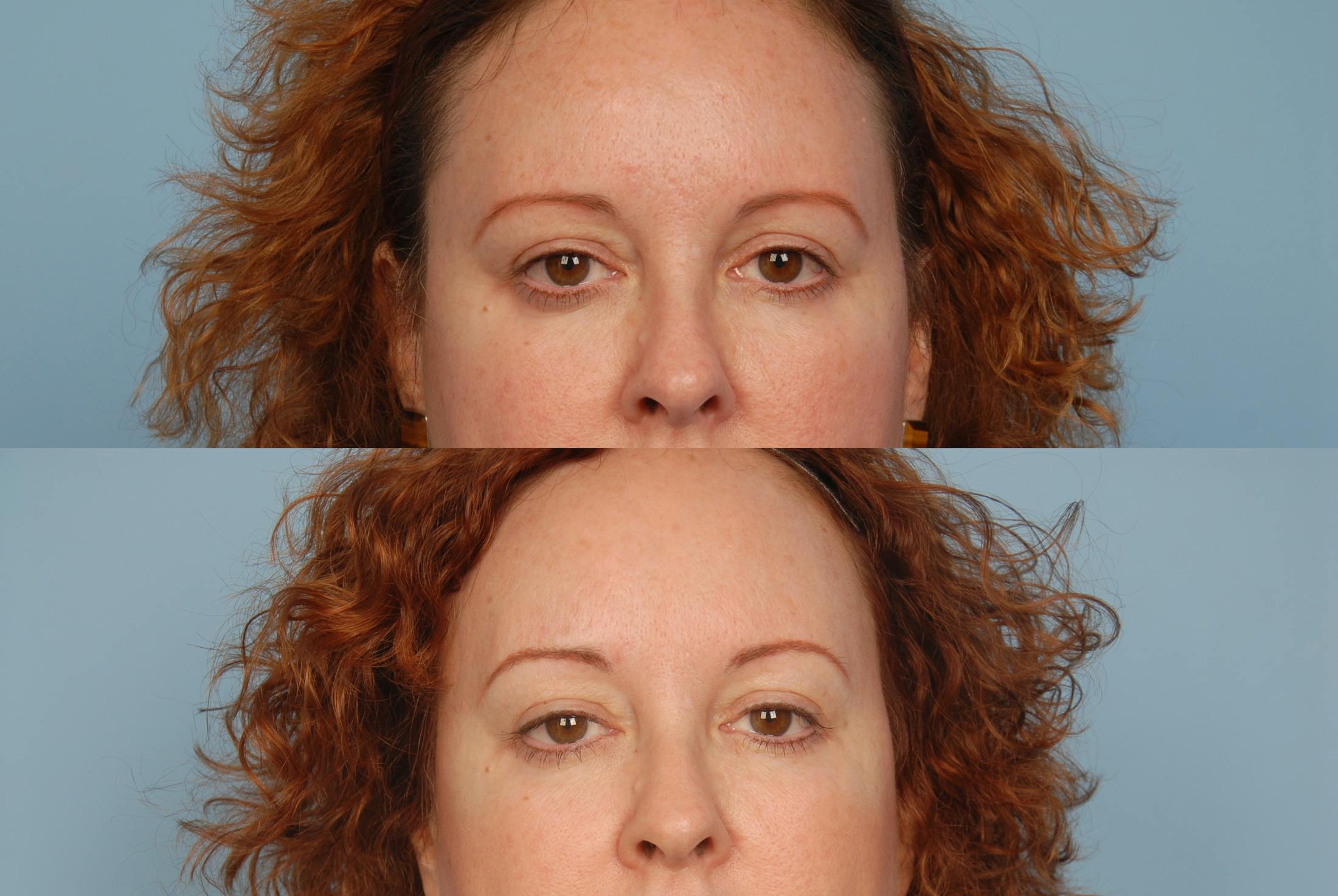 Photoderm Before & After Gallery - Patient 42065727 - Image 2