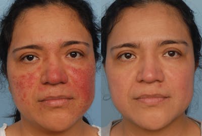 Acne Treatment / Aviclear Before & After Gallery - Patient 808377 - Image 1