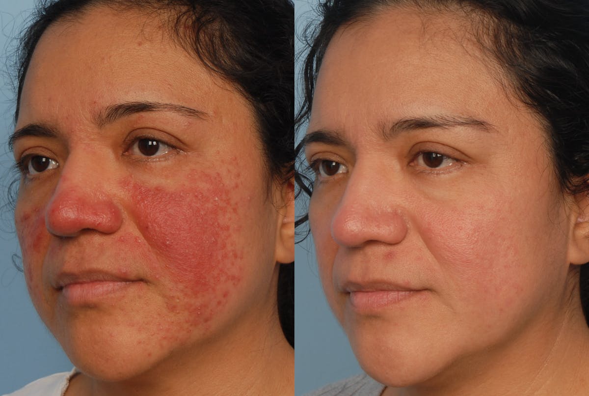 IPL Before & After Gallery - Patient 48635327 - Image 2