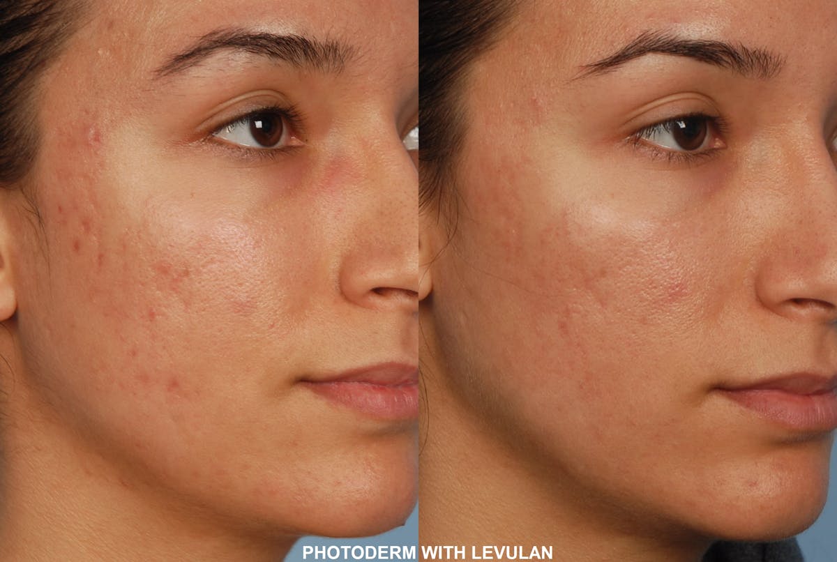 Photoderm Before & After Gallery - Patient 48635494 - Image 1