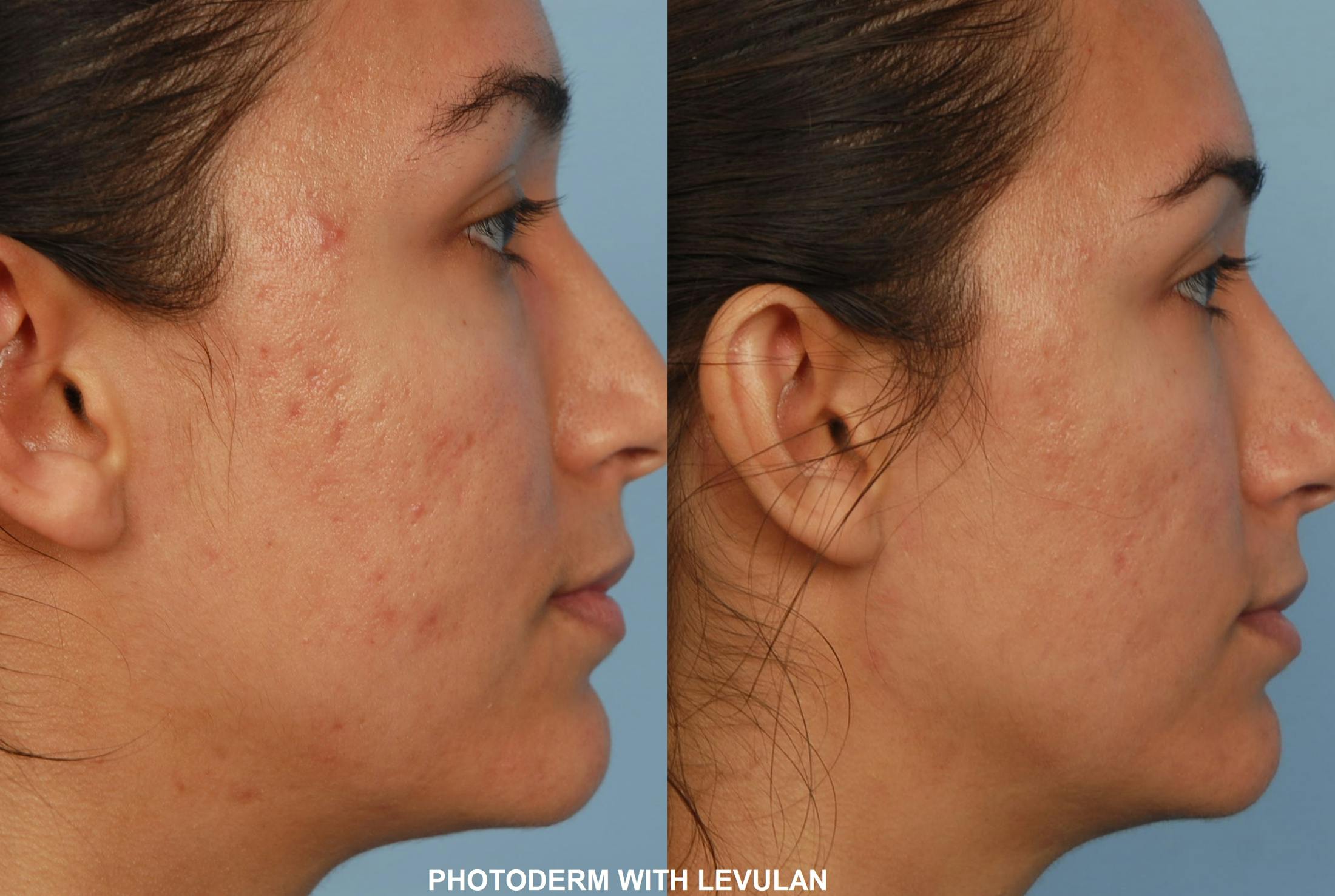 Photoderm Before & After Gallery - Patient 48635494 - Image 2