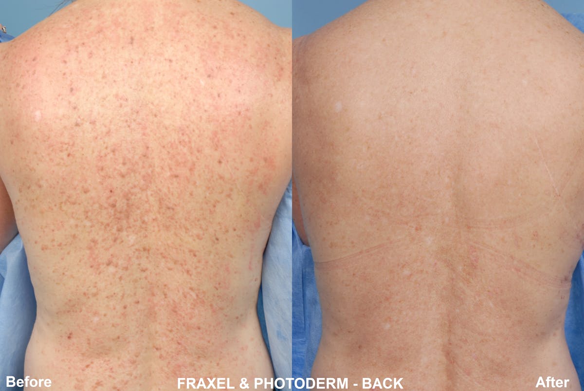 Fraxel Laser Before & After Gallery - Patient 48636697 - Image 1