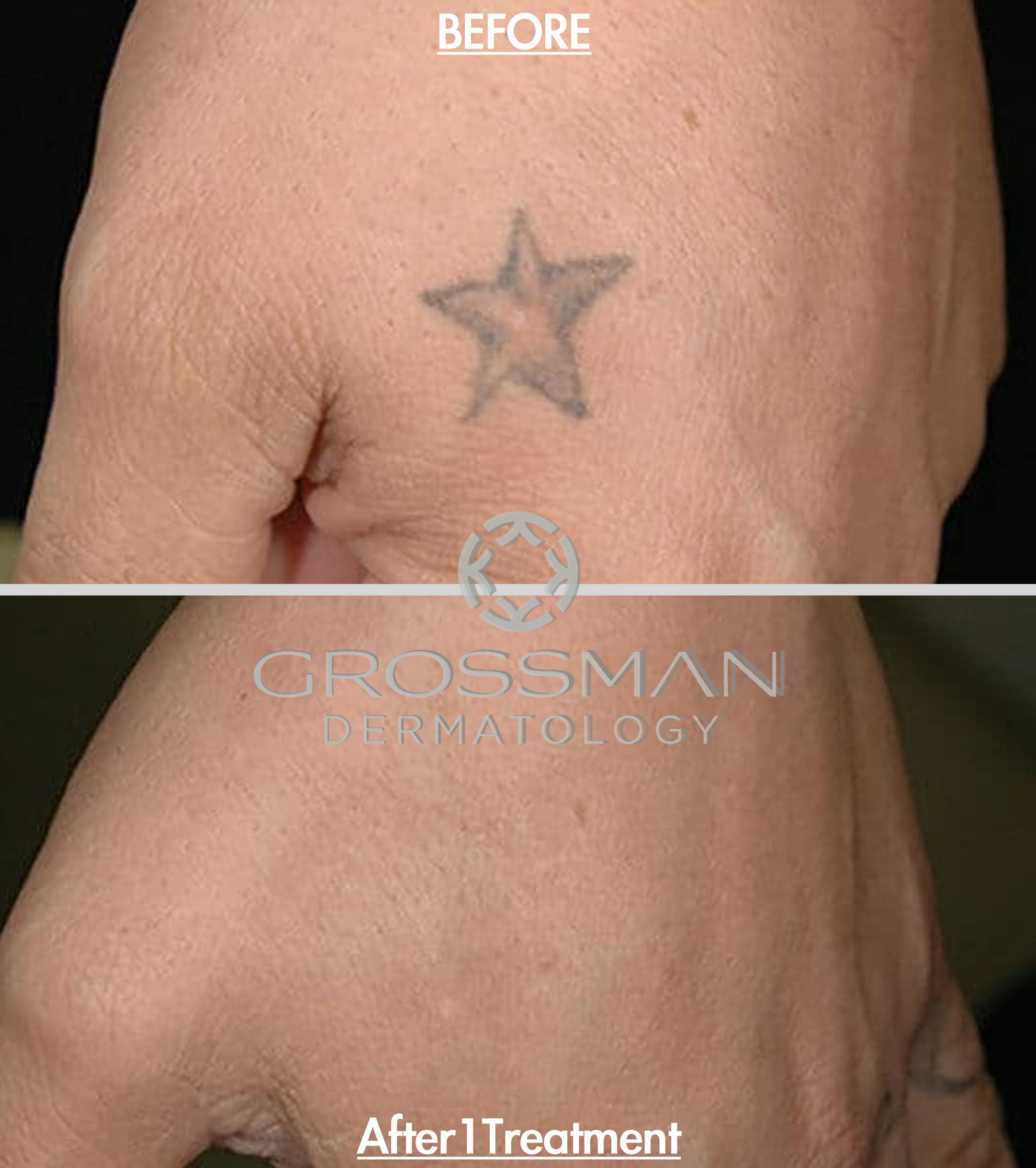 Patient 48639781 | Laser Tattoo Removal Before & After Photos | Grossman  Dermatology
