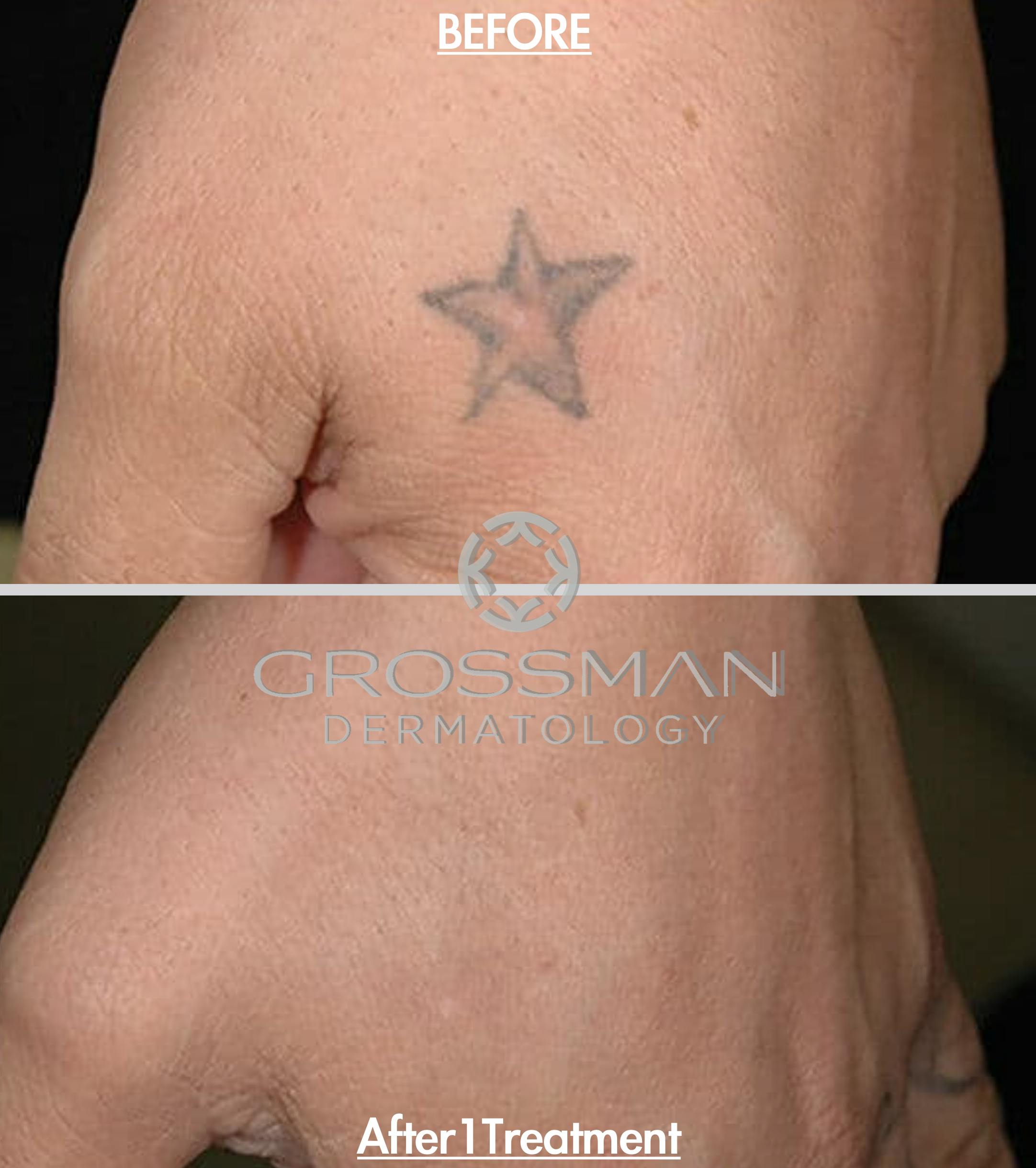 Patient 48639781 | Laser Tattoo Removal Before & After Photos | Grossman Dermatology Patient 48639781 | Laser Tattoo Removal Before & After Photos | Grossman Dermatology