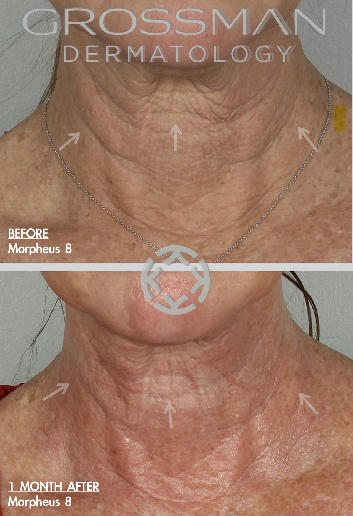 Morpheus8  Before & After Gallery - Patient 48639810 - Image 1