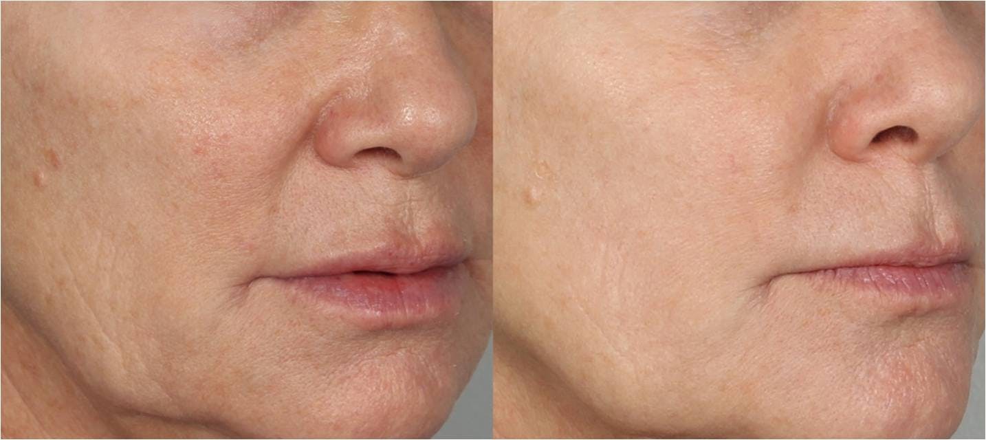 Morpheus8  Before & After Gallery - Patient 48639811 - Image 1
