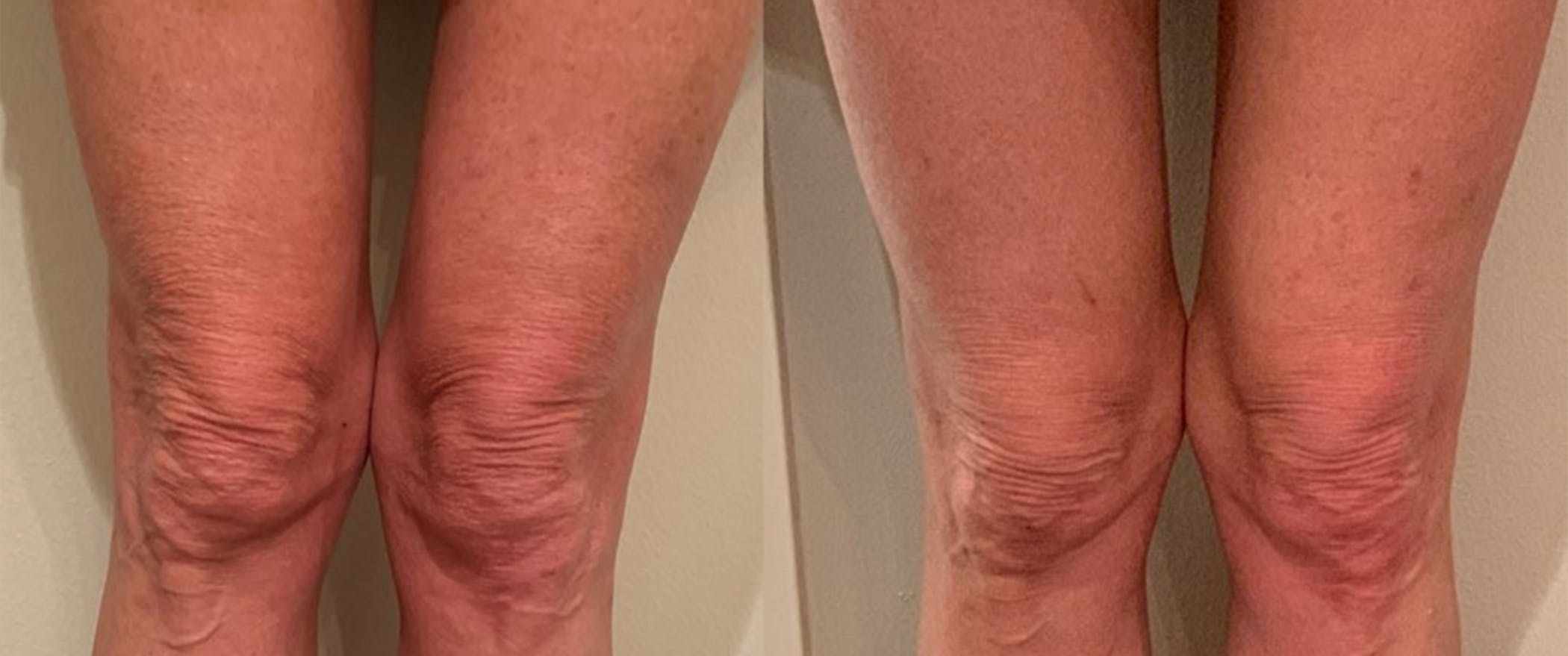 Hyperdilute Sculptra Before & After Gallery - Patient 171447209 - Image 1