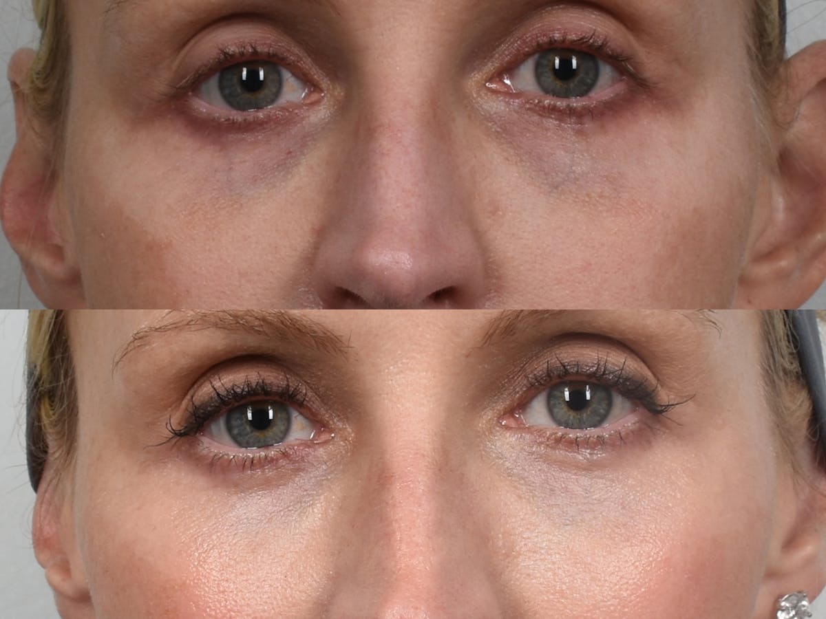 Microneedling Before & After Gallery - Patient 171447279 - Image 1