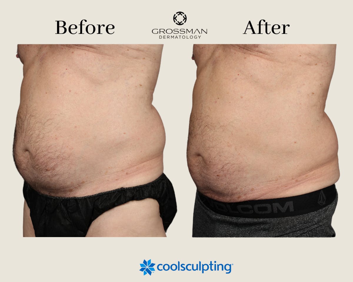 Coolsculpting Miami Before And After Images