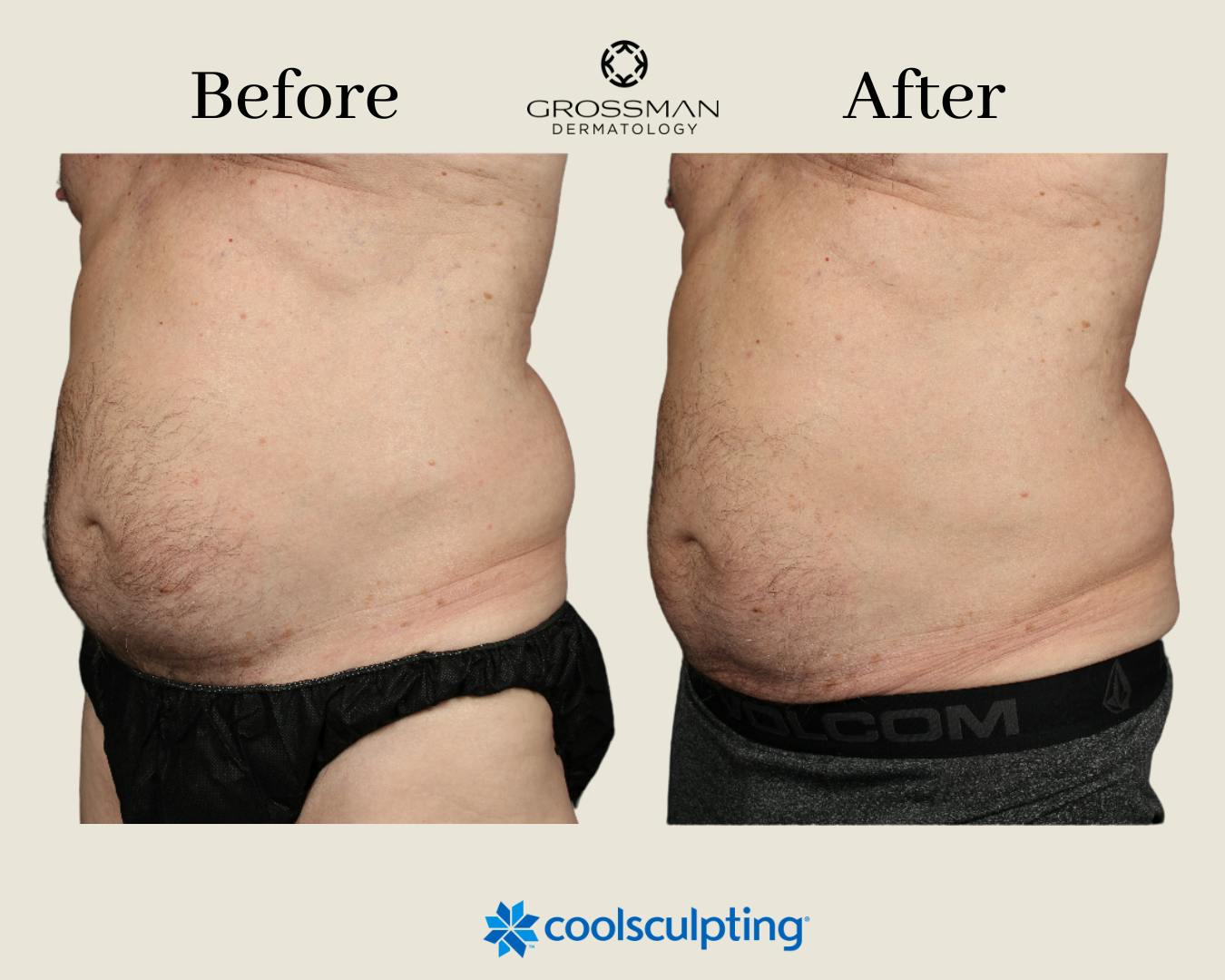 CoolSculpting Before & After Gallery - Patient 145833594 - Image 1