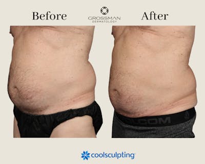 Non-Invasive Fat Reduction Before & After Gallery - Patient 145833594 - Image 1