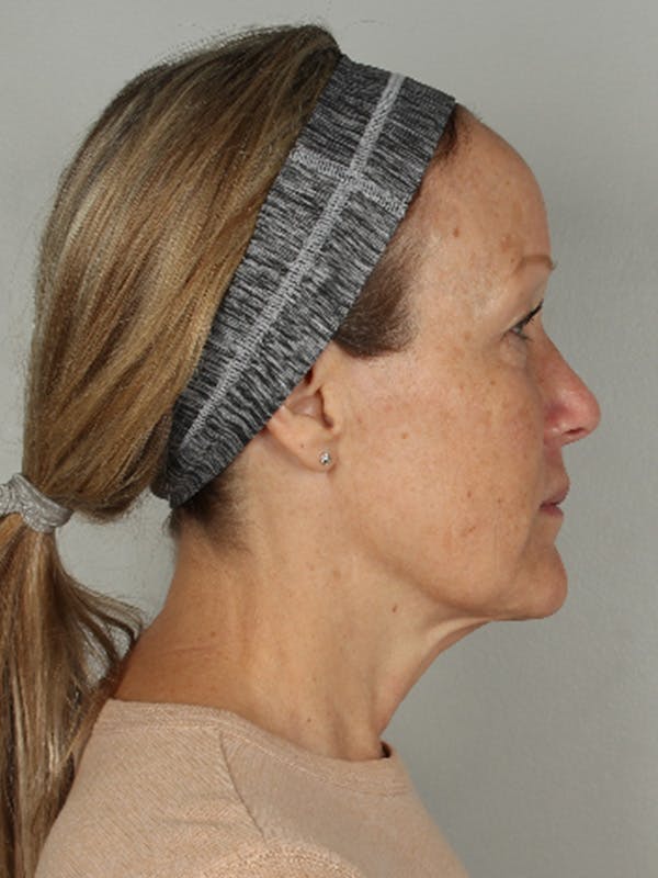 My Ellavate Before & After Gallery - Patient 146779422 - Image 4