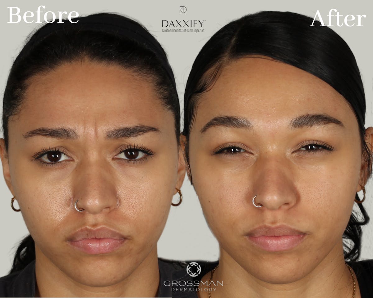 Botox & Neuromodulators Before & After Gallery - Patient 144947362 - Image 1