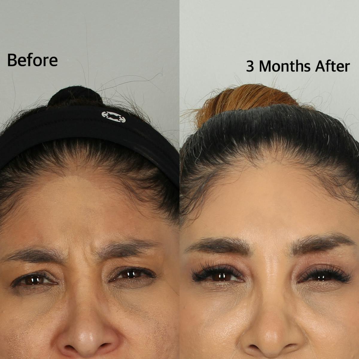 Botox & Neuromodulators Before & After Gallery - Patient 154774274 - Image 1