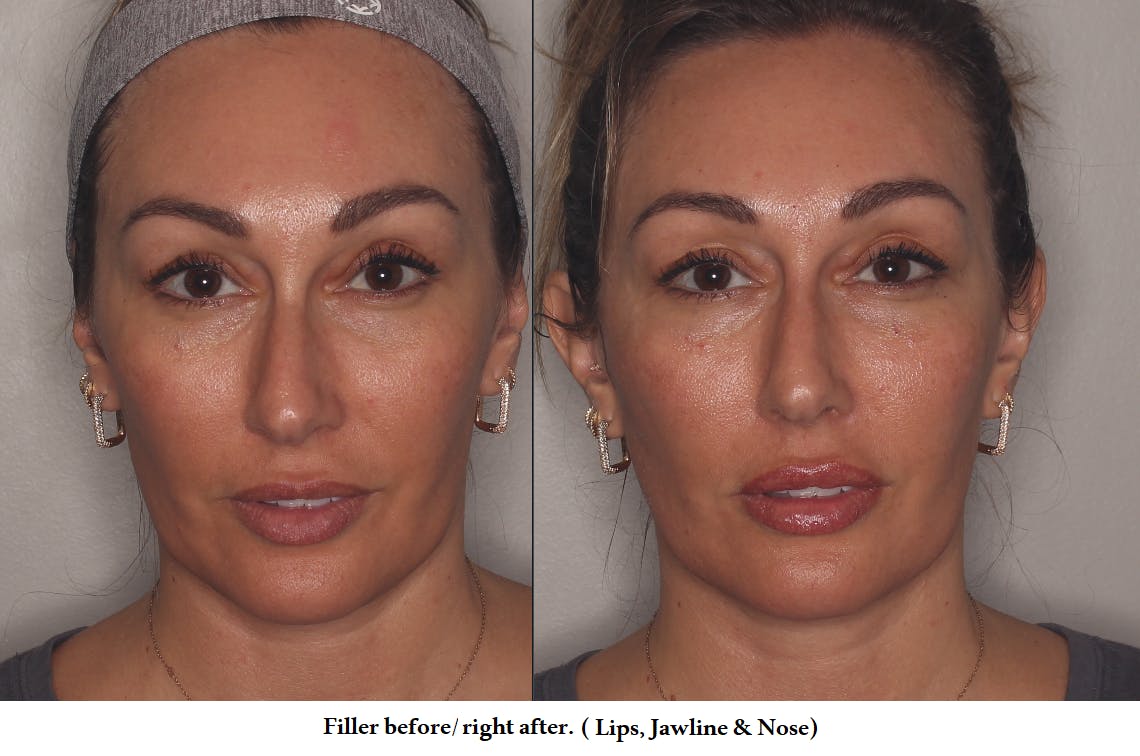 Lower Face Before & After Gallery - Patient 263459 - Image 1