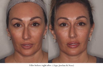 Lower Face Before & After Gallery - Patient 263459 - Image 1