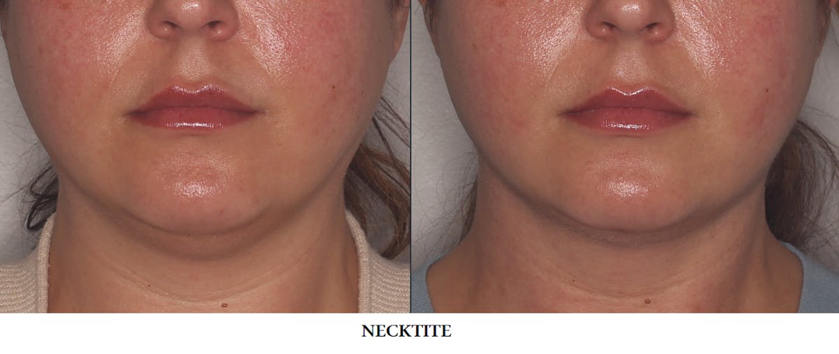 FaceTite & NeckTite Before & After Gallery - Patient 322873 - Image 1
