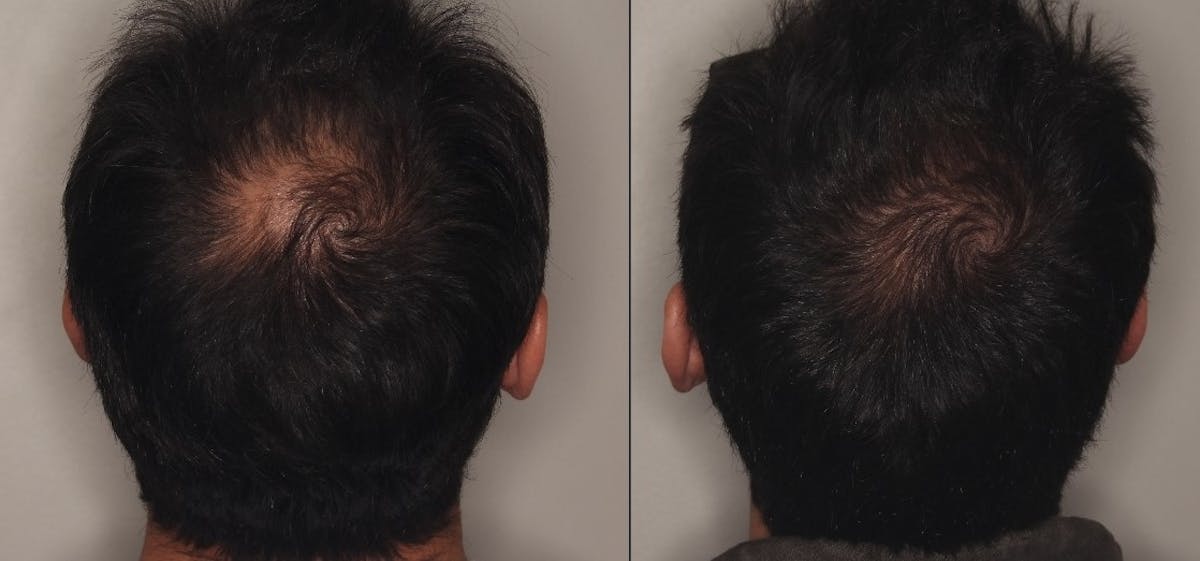 PRP Before & After Gallery - Patient 243465 - Image 1
