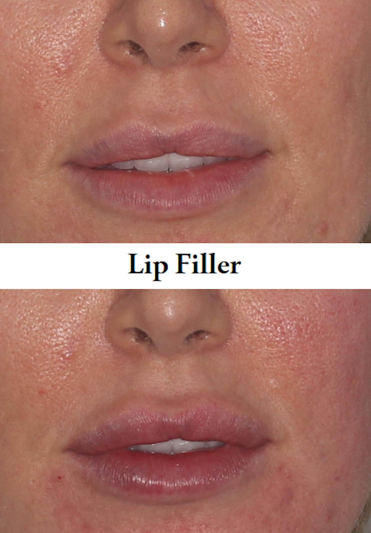 Lips Before & After Gallery - Patient 893376 - Image 1