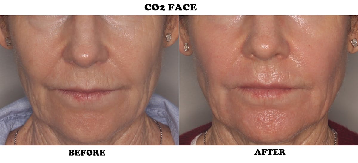 CO2 Laser Resurfacing Before & After Gallery - Patient 324102 - Image 1