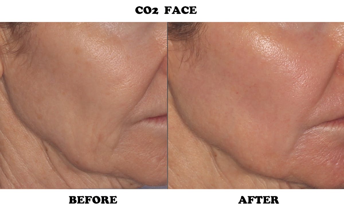 CO2 Laser Resurfacing Before & After Gallery - Patient 424108 - Image 2