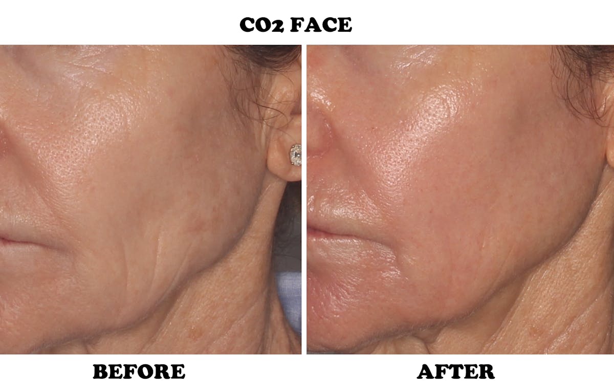 CO2 Laser Resurfacing Before & After Gallery - Patient 424108 - Image 1