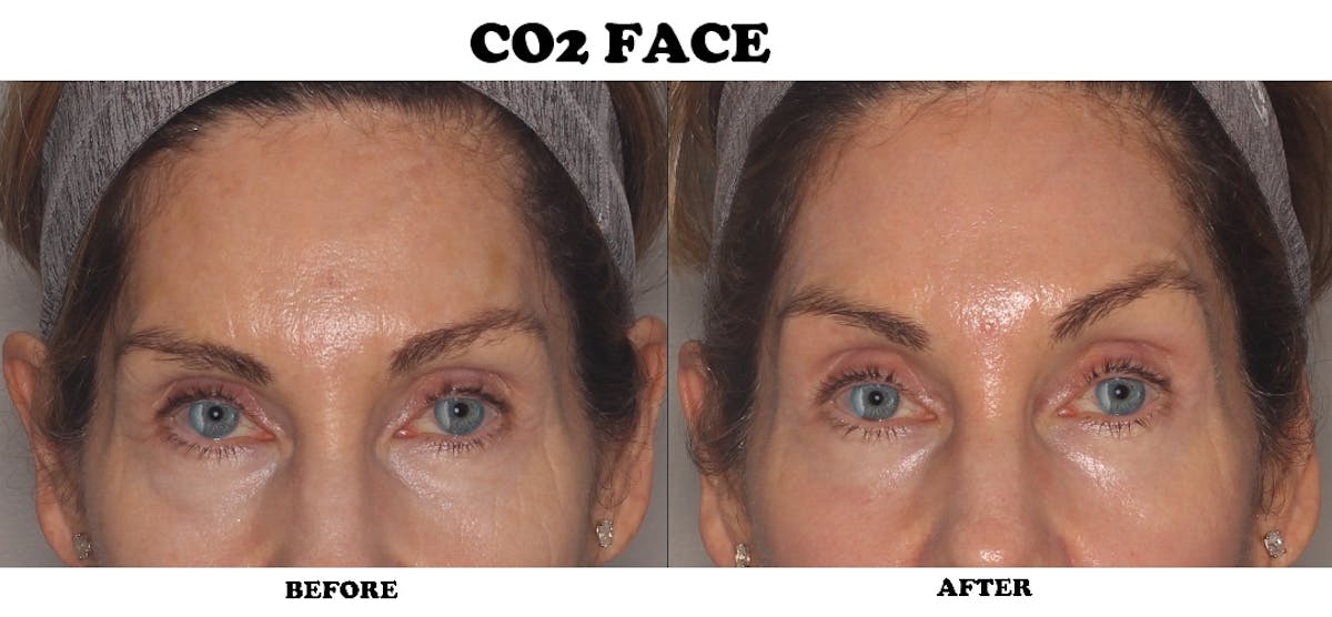CO2 Laser Resurfacing Before & After Gallery - Patient 303149 - Image 1