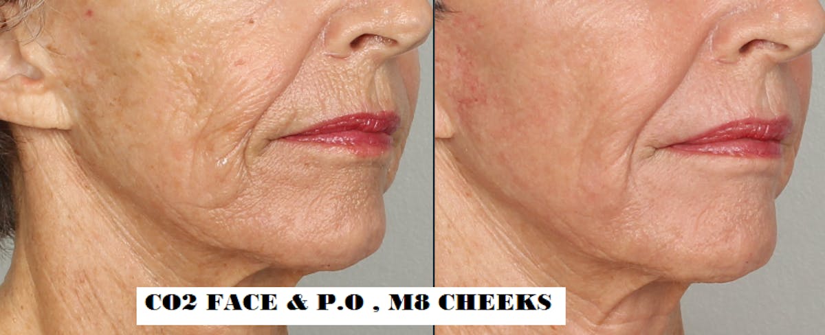 M8 Before & After Gallery - Patient 255616 - Image 1