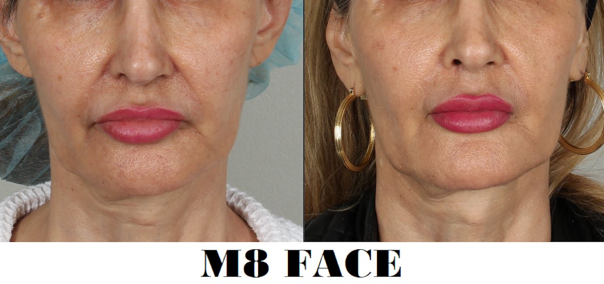 M8 Before & After Gallery - Patient 387680 - Image 1