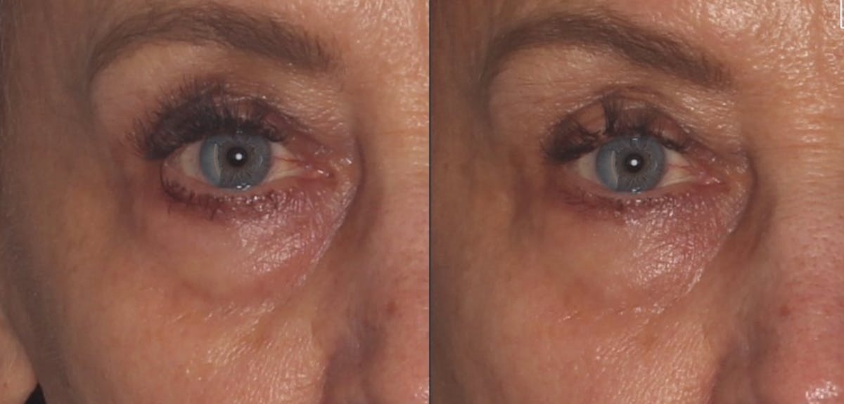 MicroFat Before & After Gallery - Patient 563980 - Image 1